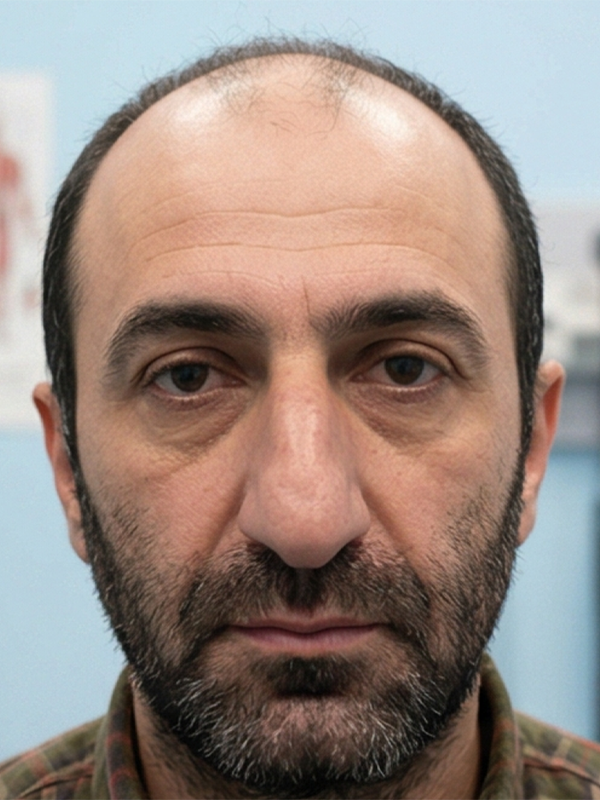 Ön Saç Çizgisi Yenileme önce