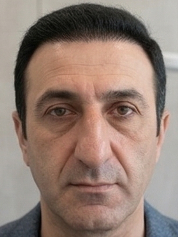 Ön Saç Çizgisi Yenileme sonra